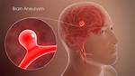 Where Do Aneurysms Occur?