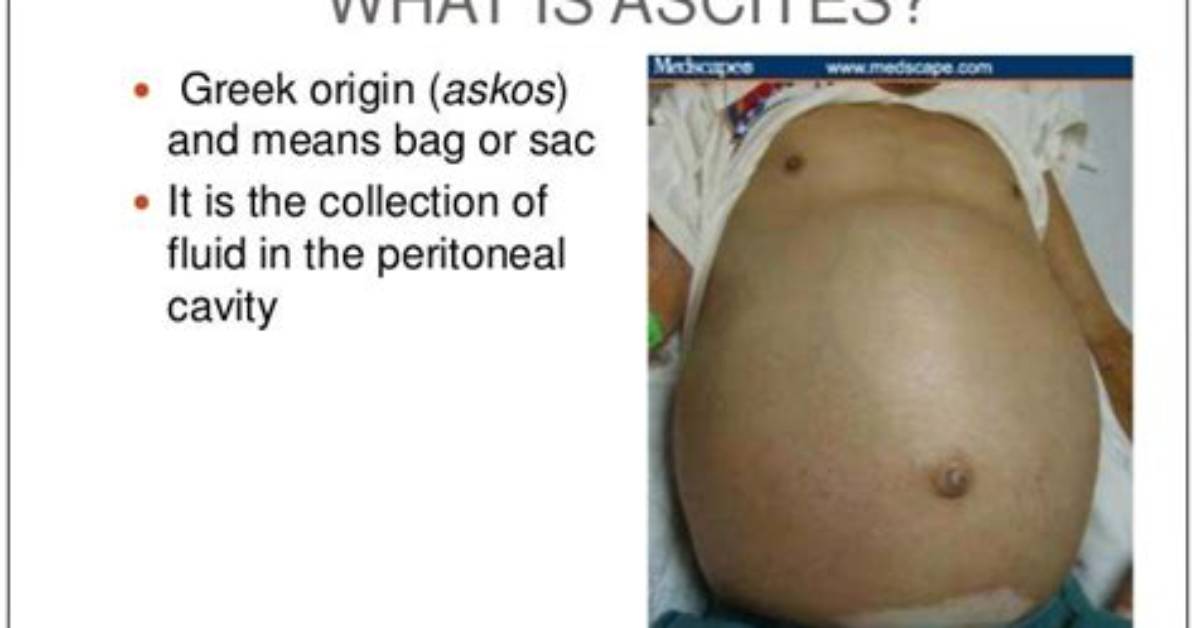 Where Do Ascites Form?