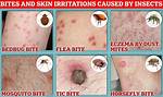 Where Do Bed Bugs Bite?