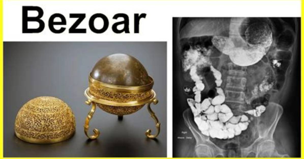 Where Do Bezoars Form?
