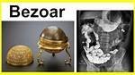 Where Do Bezoars Form?