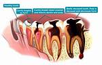 Where Do Cavities Come from?