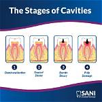 Where Do Cavities Start?