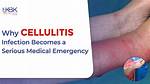 Where Do Cellulitis Come from?