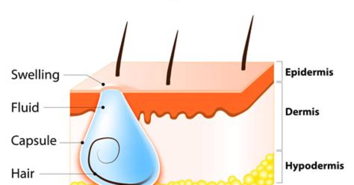 Where Do Cysts Form?