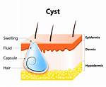 Where Do Cysts Form?
