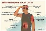 Where Do Hematomas Come from?