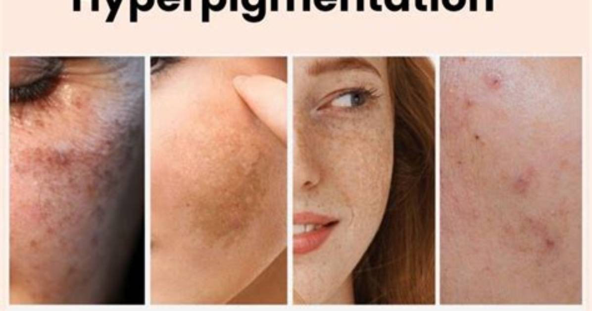 Where Do Hyperpigmentation Come from?