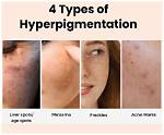Where Do Hyperpigmentation Come from?