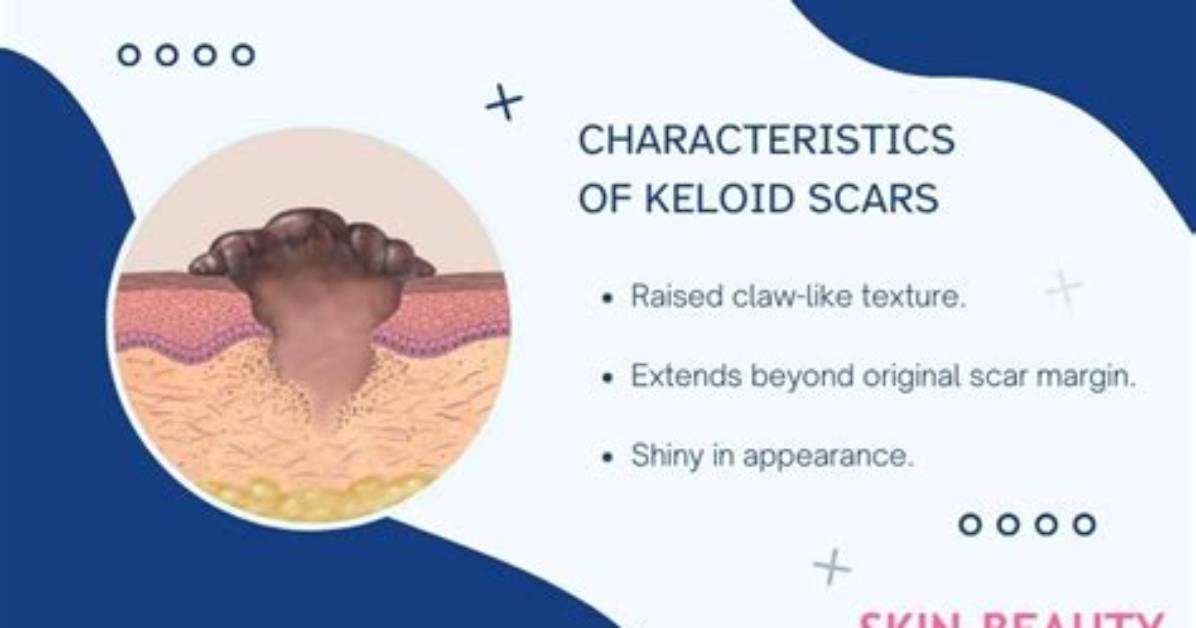 Where Do Keloid Scars Form?