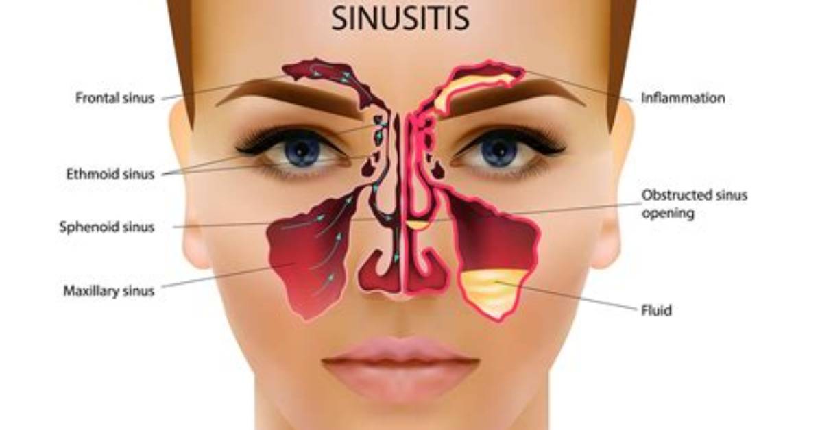 Where Do Sinuses Hurt?