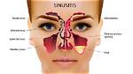 Where Do Sinuses Hurt?