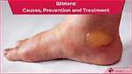 Where Do We Get Blisters?