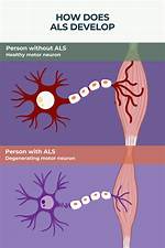 Where Does Als Begin?