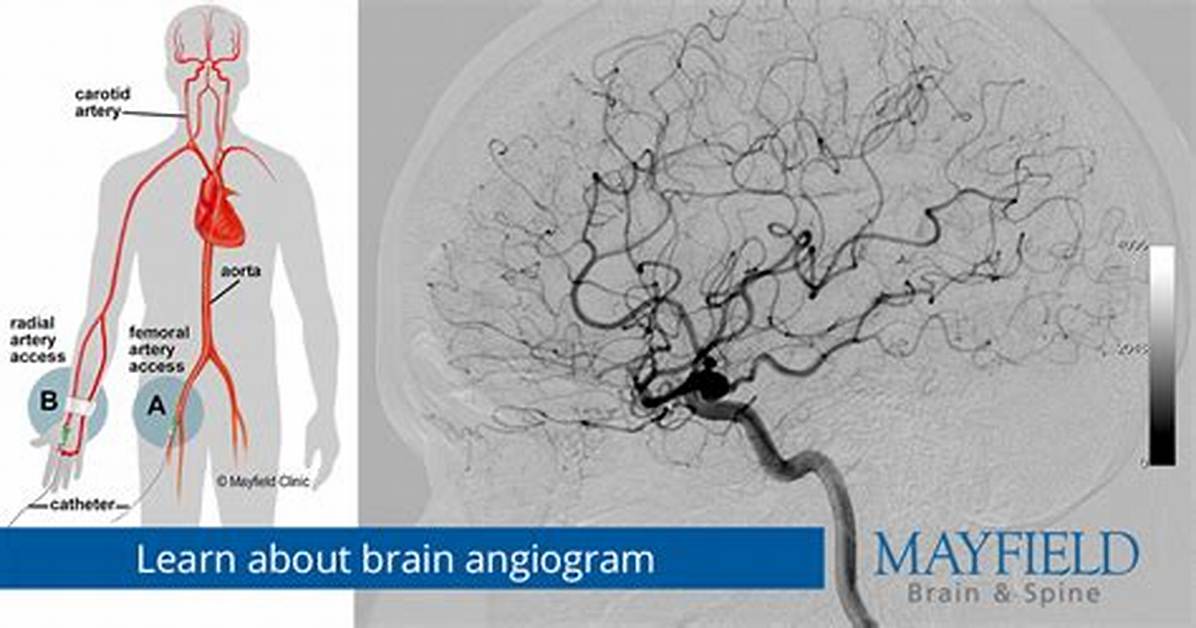 Where Does Angiogram Start?