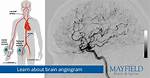 Where Does Angiogram Start?