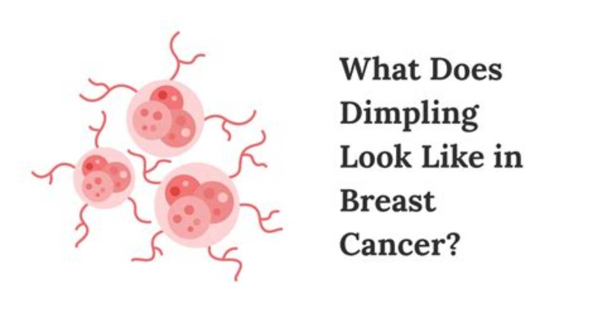Where Does Breast Dimpling Occur?