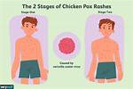 Where Does Chickenpox Come from?