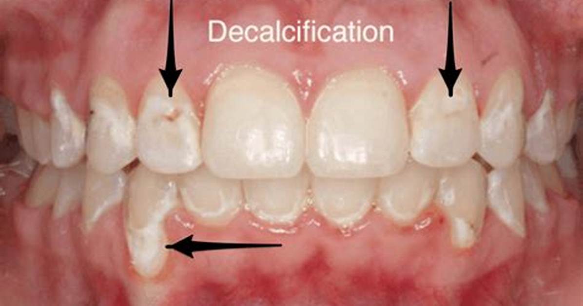 Where Does Decalcification Occur?