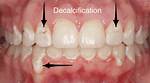 Where Does Decalcification Occur?
