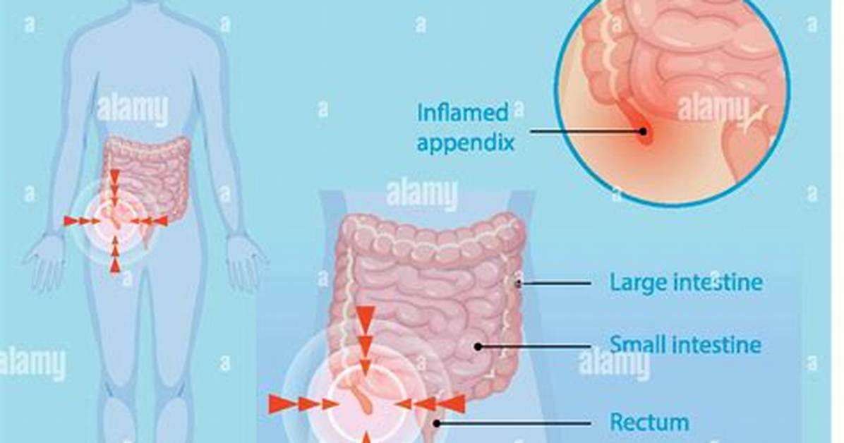 Where Does It Hurt When Your Appendix Ruptures?