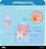 Where Does It Hurt When Your Appendix Ruptures?