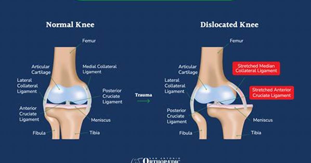 Where Does Knee Dislocation Occur?