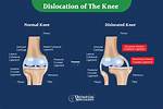 Where Does Knee Dislocation Occur?
