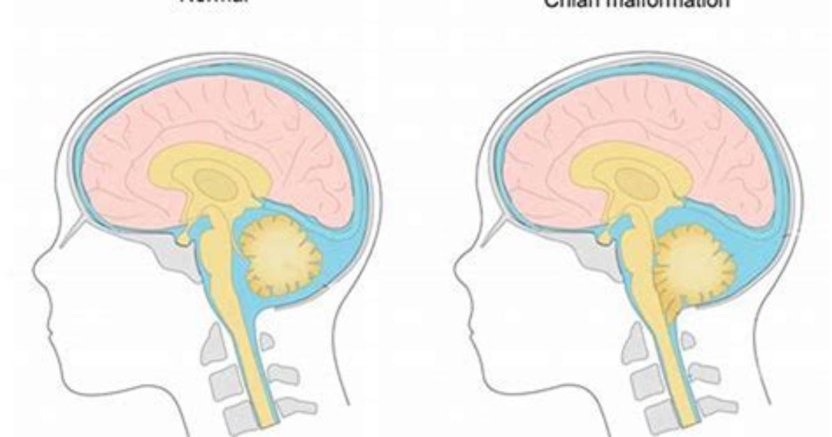 Where Does Malformation Come from?