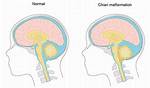 Where Does Malformation Come from?