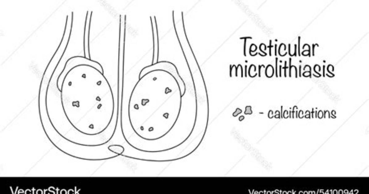 Where Does Microlithiasis Come from?
