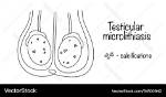 Where Does Microlithiasis Come from?