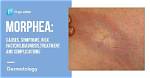 Where Does Morphea Come from?