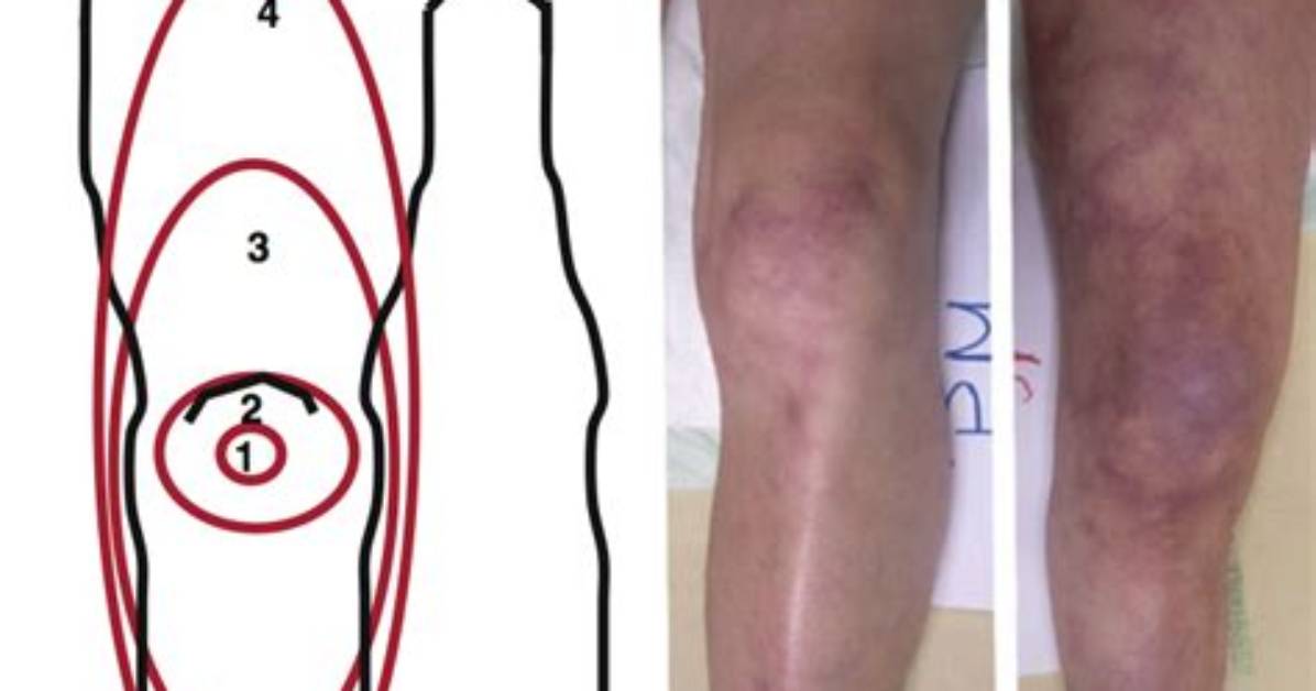 Where Does Mottling Start?