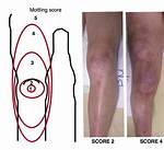 Where Does Mottling Start?