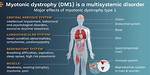 Where Does Myotonic Dystrophy Affect?