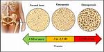 Where Does Osteopenia Mean?