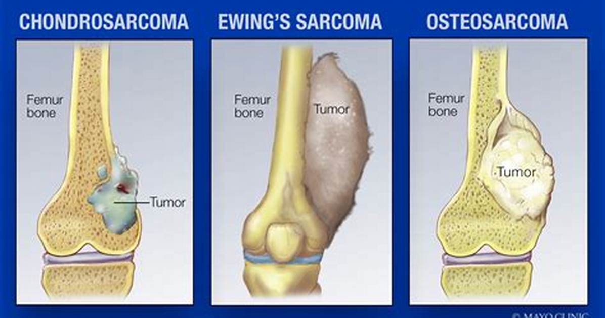 Where Does Osteosarcoma Usually Start?