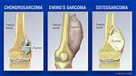Where Does Osteosarcoma Usually Start?