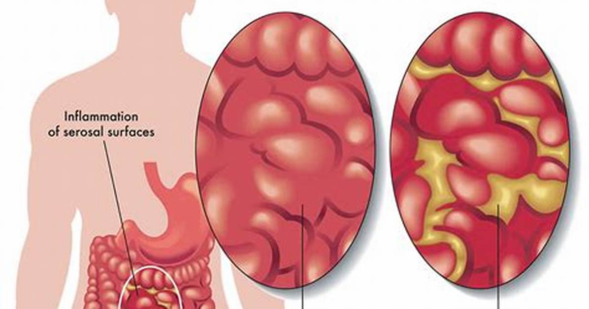 Where Does Peritonitis Affect?