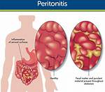 Where Does Peritonitis Affect?
