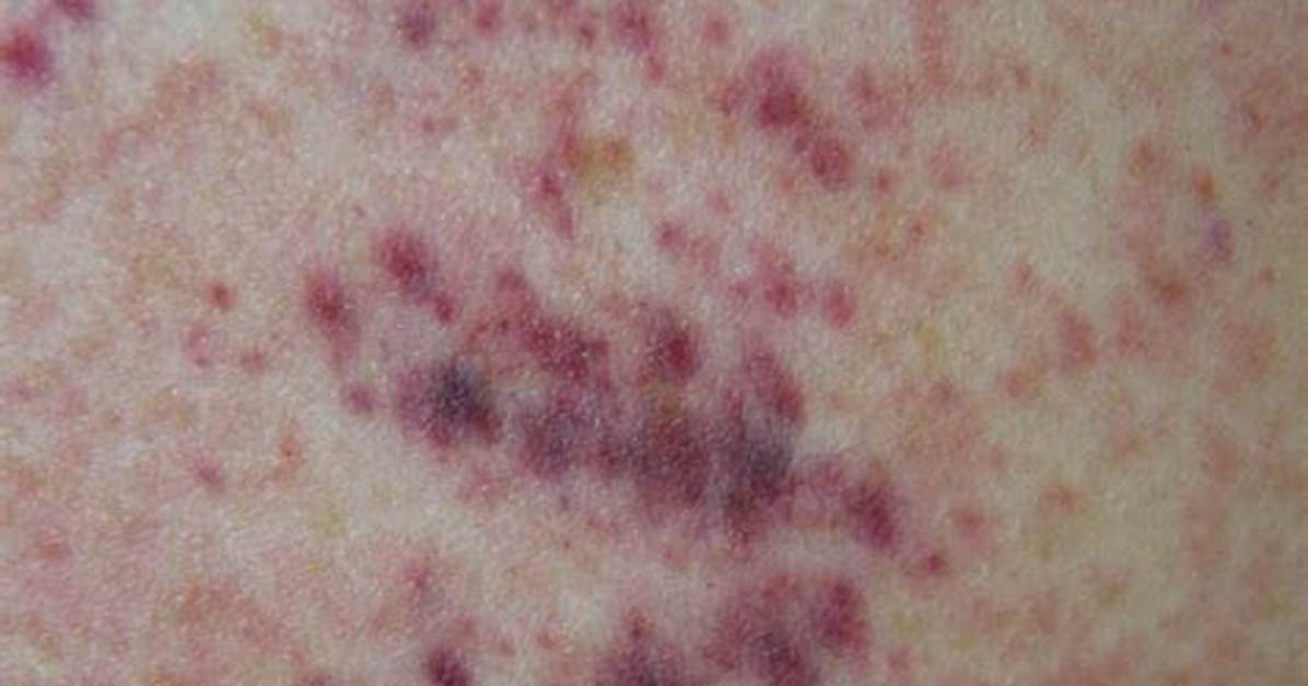 Where Does Petechiae Appear?