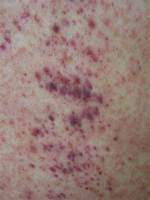 Where Does Petechiae Appear?