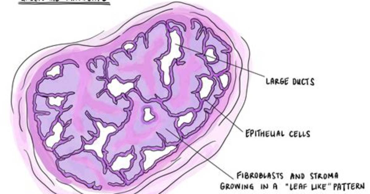 Where Does Phyllodes Come from?