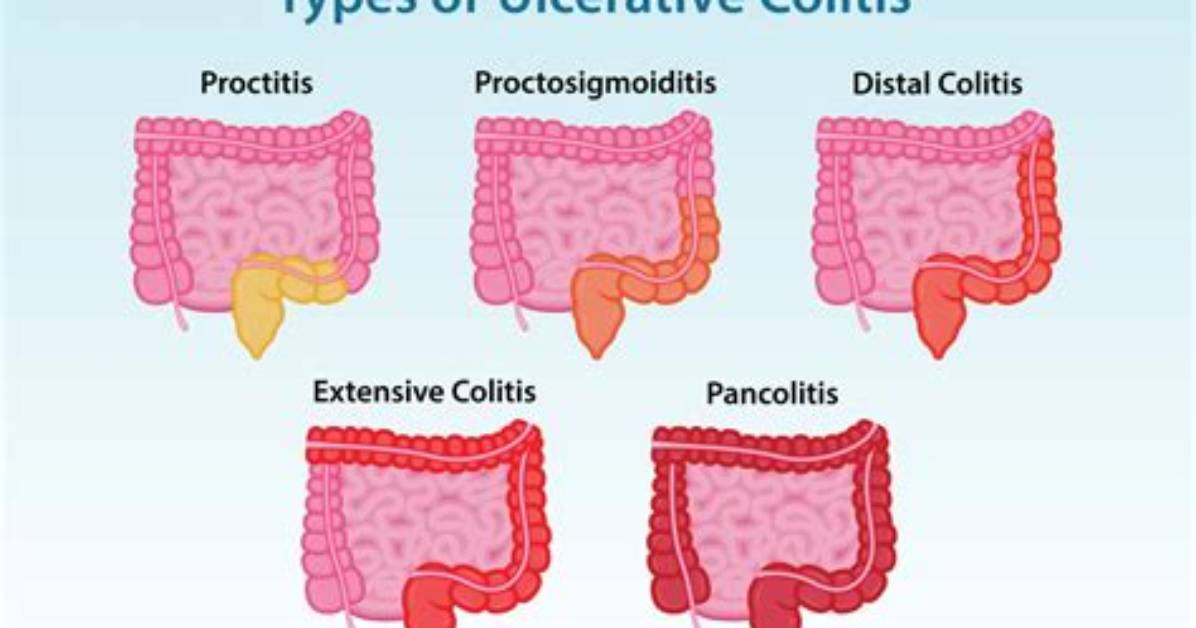 Where Does Proctitis Occur?