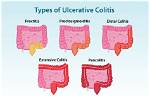Where Does Proctitis Occur?