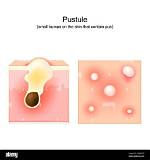 Where Does Pustule Come from?