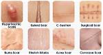 Where Does Scars Come from?
