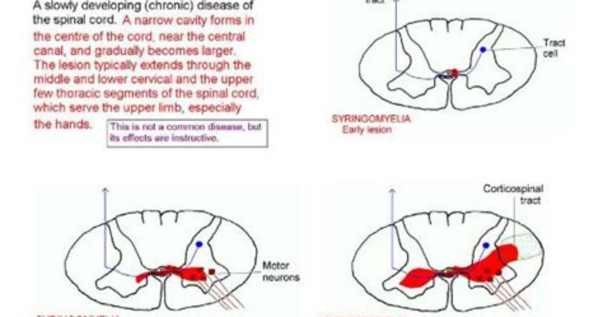 Where Does Syringomyelia Affect?