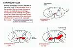Where Does Syringomyelia Affect?